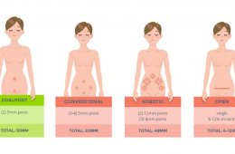 Robotic Surgery hysterectomy