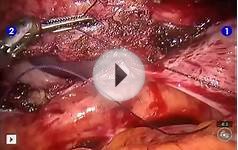Robotic surgery hysterectomy Prof Dr Ahmet Göçmen